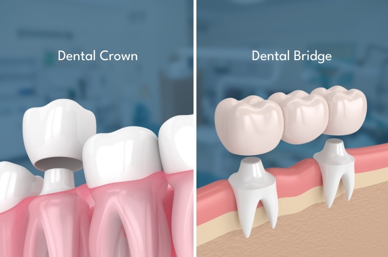 Crowns & Bridges