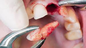 Tooth Extraction